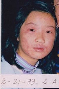 '图1：照片摄于一九九九年二月，长达四年的皮炎还相当严重'