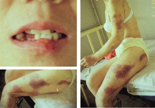 Foto Ren Ping yang diambil 13 hari setelah dipukuli dan diperkosa oleh seorang petugas polisi