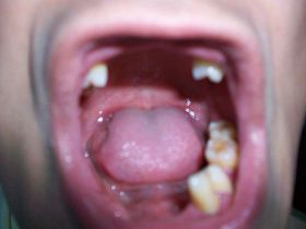 图为大部份牙脱落后的口腔。