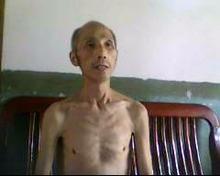 Mr. Hu Heping after he was tortured.